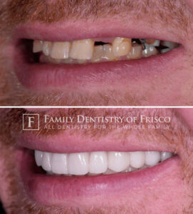 Before and After Implant